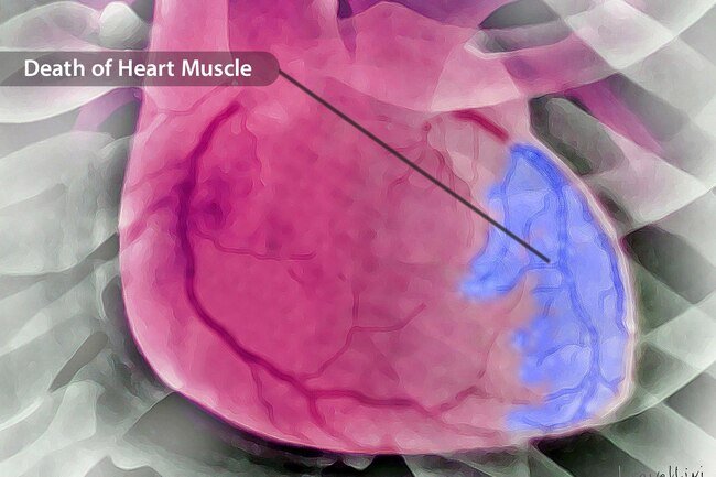 Unlike cardiac arrest, your heart does not usually stop during a heart attack.