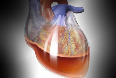 Cardiac tamponade is a condition in which the pressurized protective sack around the heart (pericardium) fills with blood and compromised heart function.