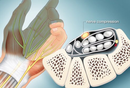 Carpal tunnel syndrome comes on gradually.