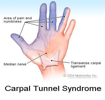 Picture of carpal tunnel syndrome Picture of carpal tunnel syndrome