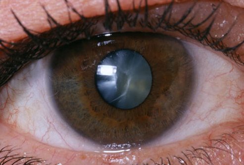 Cataracts are a painless clouding of the internal lens of your eye.