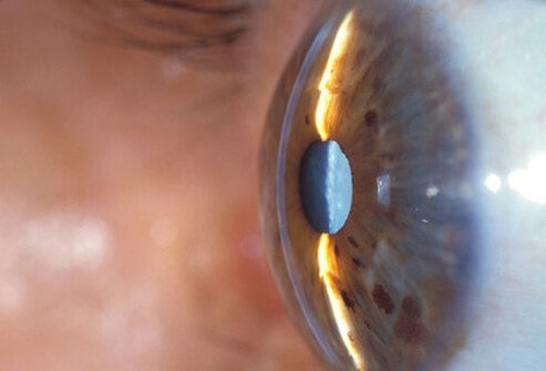 Cataracts can be diagnosed with an eye exam.