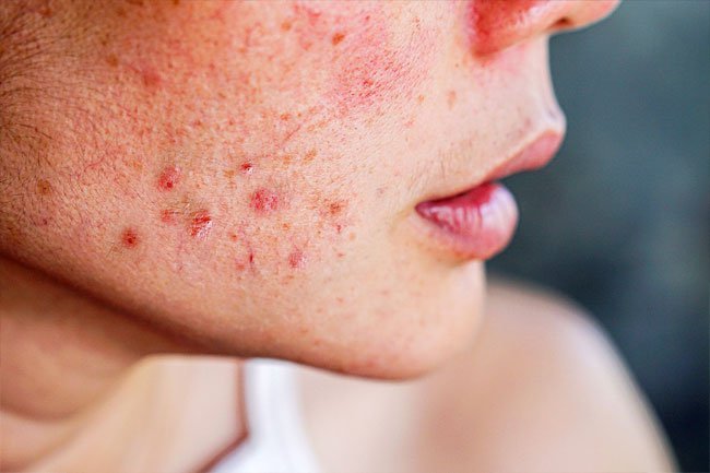 Acne may be the result of hormones, family history and certain medications. 