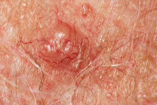 Have skin lesions that don't heal or change appearance looked at by a doctor. 