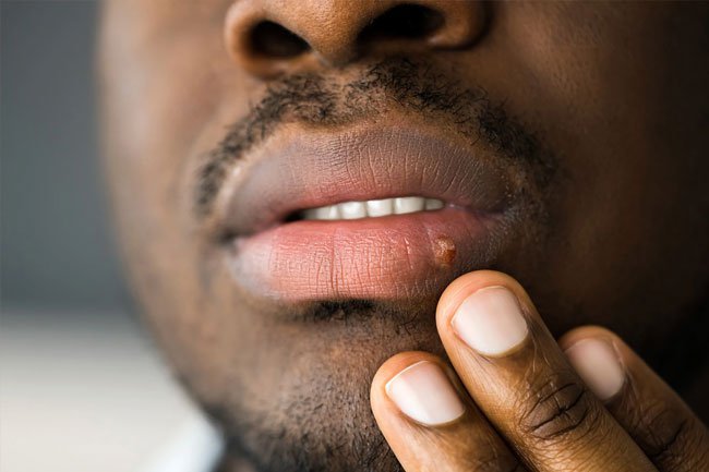 Blisters may appear on the genitals or mouth as a result of infection with the herpes simplex virus. 
