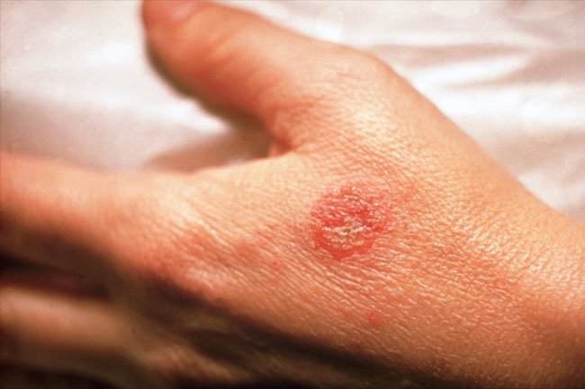Red coin-shaped lesions that itch and burn may be due to nummular eczema. 