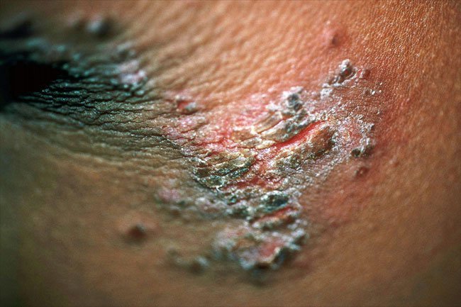 Impetigo causes crusty lesions on the skin and it is contagious.