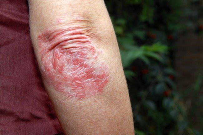 Psoriasis is an autoimmune disease that causes a buildup of rough, scaly skin.