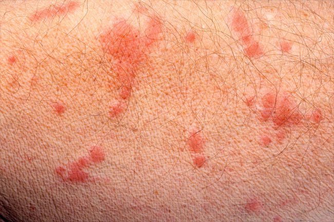 Scabies is a skin condition caused by skin mites that burrow into the skin. 