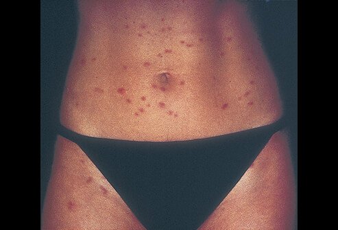 Picture of Cercarial Dermatitis: Swimmer's Itch