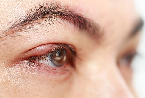 The two types of stye are hordeolum and chalazion. The two types of stye are hordeolum and chalazion.