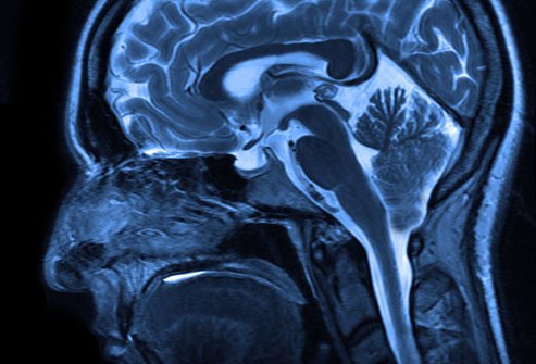 Chiari malformation symptoms include vomiting, muscle weakness in the head and face, difficulty swallowing, varying degrees of mental impairment, headache, neck pain, progressive scoliosis (curvature of the spine), difficulty with balance and coordination, and others. It can be life threatening if it affects the mouth and throat.