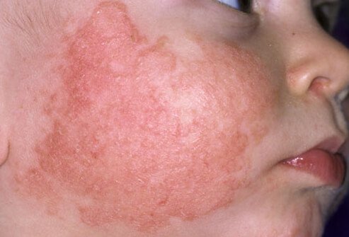 Eczema, also known as atopic dermatitis, is common in children with allergies and asthma.