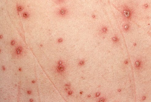 An infection with varicella, the virus that causes chickenpox, generally starts as a fever, and then cold symptoms and the rash develop.