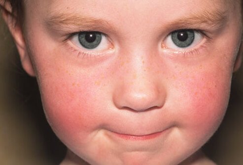 Parvovirus B19 is the virus that causes fifth disease. It is a very common illness that is usually mild and resolves without treatment. 