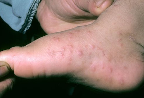 Coxsackievirus is the cause of hand, foot, and mouth disease.