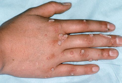 Warts on the hand and fingers.