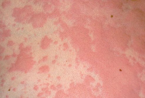 Hives are the result of an allergic reaction. They appear as small red itchy bumps or welts, which may be painful as well.