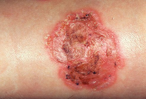 Impetigo can occur anywhere on the body, but it's commonly found around the mouth and nose.