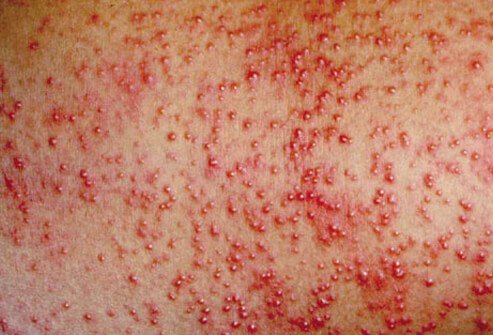 Blocked sweat glands cause heat rash, which results in a red pimply eruption on the head and neck.