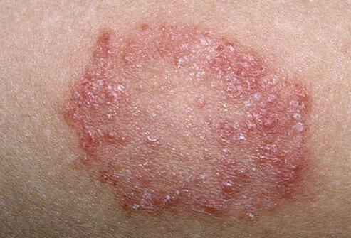 The cause of ringworm is a common fungus that infects the skin and causes a scaly and bumpy red patch to form on the infected area.