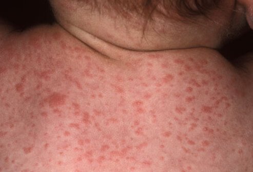 Roseola is a mild viral illness.