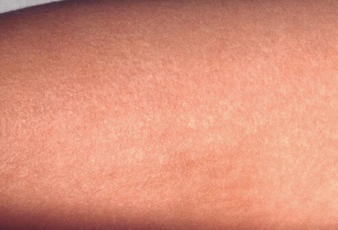 Close-up view of scarlet fever rash.