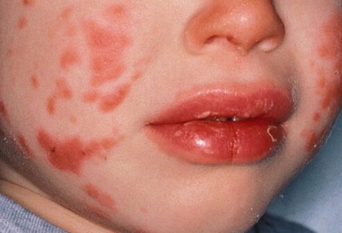 Kawasaki disease is a very serious disease that can mimic many infections.