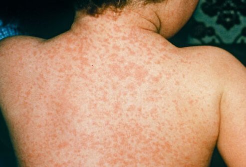 The rubeola virus causes measles, and it used to be an extremely common childhood infection prior to routine vaccination.