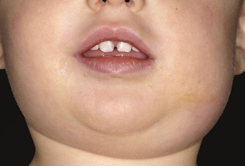 Mumps is a viral illness that typically starts with flu-like symptoms and then results in acute painful swelling of the salivary glands (parotitis).