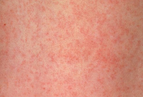 Rubella, also known as German measles, causes mild illness in most individuals.