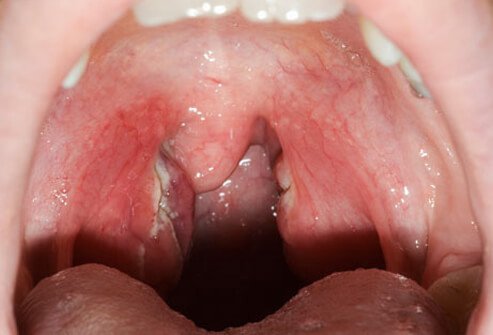 A strain of Streptococcus, a common skin bacterium, causes strep throat.