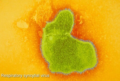 A number of different viruses cause bronchiolitis (inflammation of the small airways), which affects children less than 1 year of age.