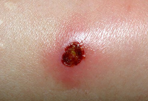MRSA, or methicillin-resistant Staph aureus, is an antibiotic-resistant organism that causes skin infections such as boils and abscesses (deep skin infections) or even worse.