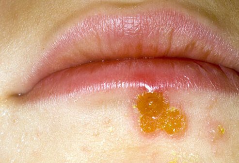 Staph or strep, two very common skin bacteria, may cause impetigo.