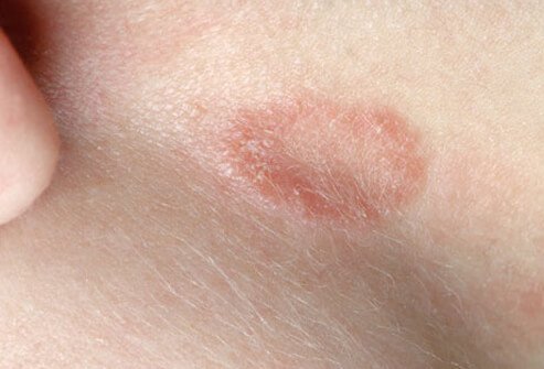 A common fungus causes ringworm.