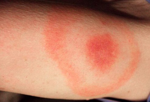Lyme disease is a common infection caused by a bacterium carried by a specific deer tick.