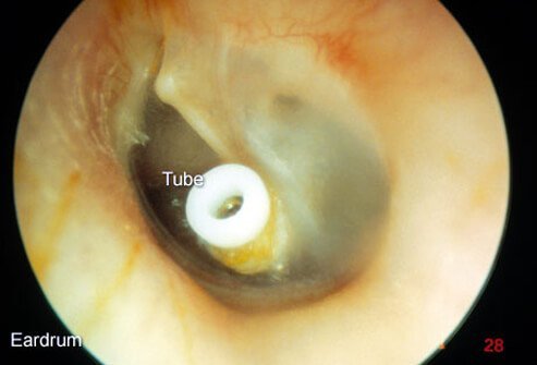 When fluid in the middle ear builds up and fails to clear up on its own or after treatment, it may need to be surgically drained.