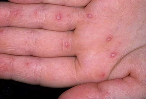 Coxsackievirus causes hand, foot, and mouth disease.