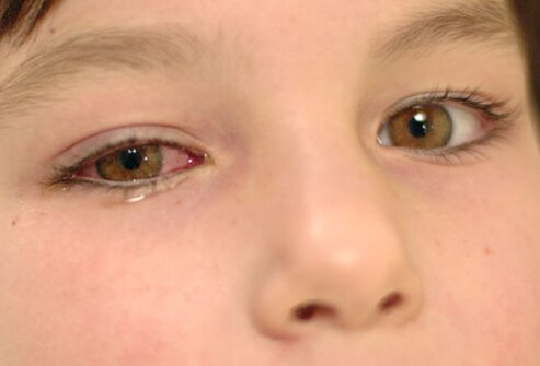Pinkeye is also called conjunctivitis.
