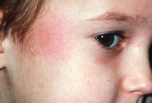 A virus called parvovirus B19 causes fifth disease.