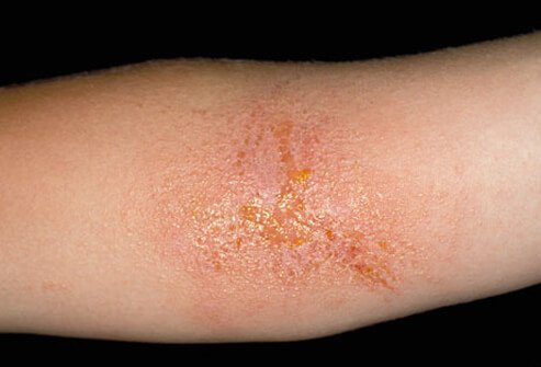 Contact dermatitis appears as a collection of small red pimples or bumps on a skin surface exposed to some sort of allergen.