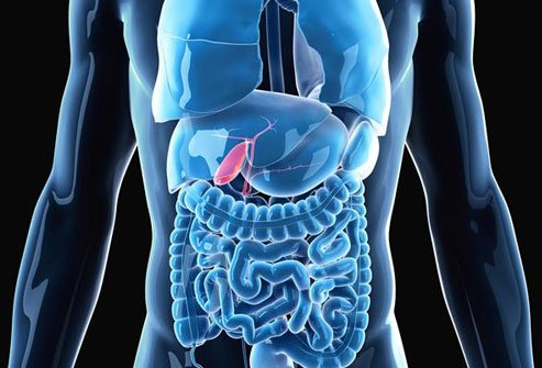 Cholelithiasis occurs when gallstones develop. If these gallstones block the bile duct, bile can build up in the gallbladder causing inflammation called cholecystitis. Cholelithiasis occurs when gallstones develop. If these gallstones block the bile duct, bile can build up in the gallbladder causing inflammation called cholecystitis.
