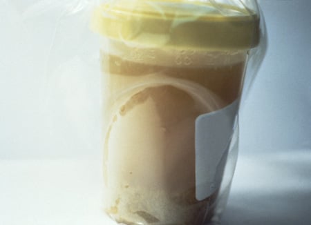 Picture of rice-water stool from a patient with cholera