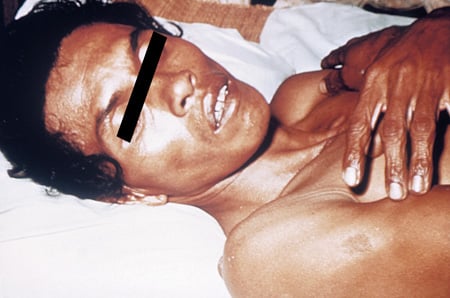 Picture of patient with washer woman hands (loss of skin elasticity), a sign of cholera.