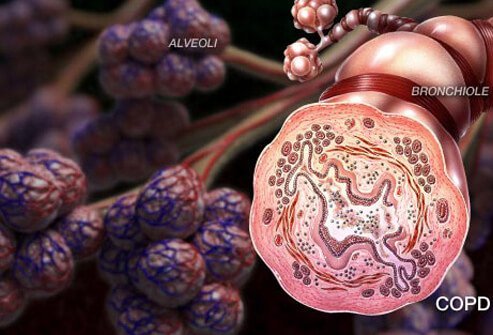 Illustration of COPD Symptoms Illustration of COPD Symptoms