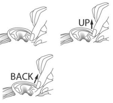 allow the drops of CIPRODEX to enter your ear canal - Illustration