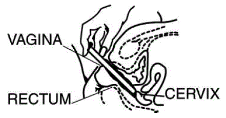 Insert into vagina as far as possible - Illustration Insert into vagina as far as possible - Illustration