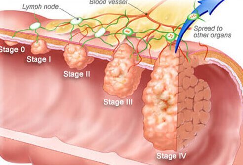 Staging is the process of determining how far a tumor has spread beyond its original location. 