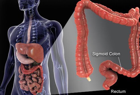 Colorectal cancer is the third most common non-skin cancer diagnosed in both men and women in the U.S.